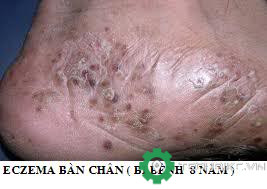eczema 1.jpg